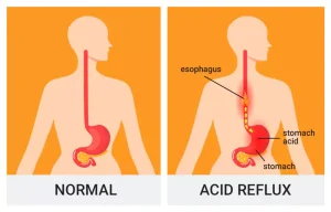 Cara Mengatasi Asam Lambung atau GERD