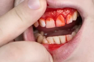 Pengobatan serta Pencegahan Gingivitis