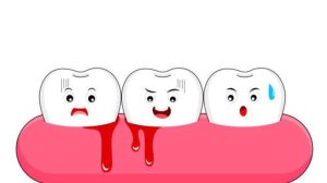 Penyebab serta Gelaja Gingivitis