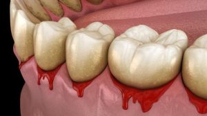 Pengobatan serta Pencegahan Gingivitis