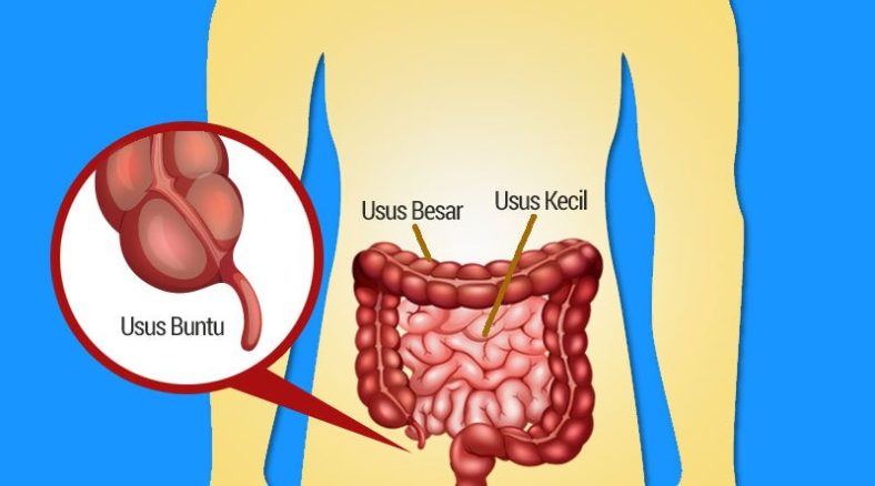 Gejala dan Penyebab Radang Usus Buntu