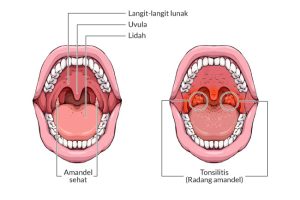 Penyebab dan Gejala Radang Tenggorokan